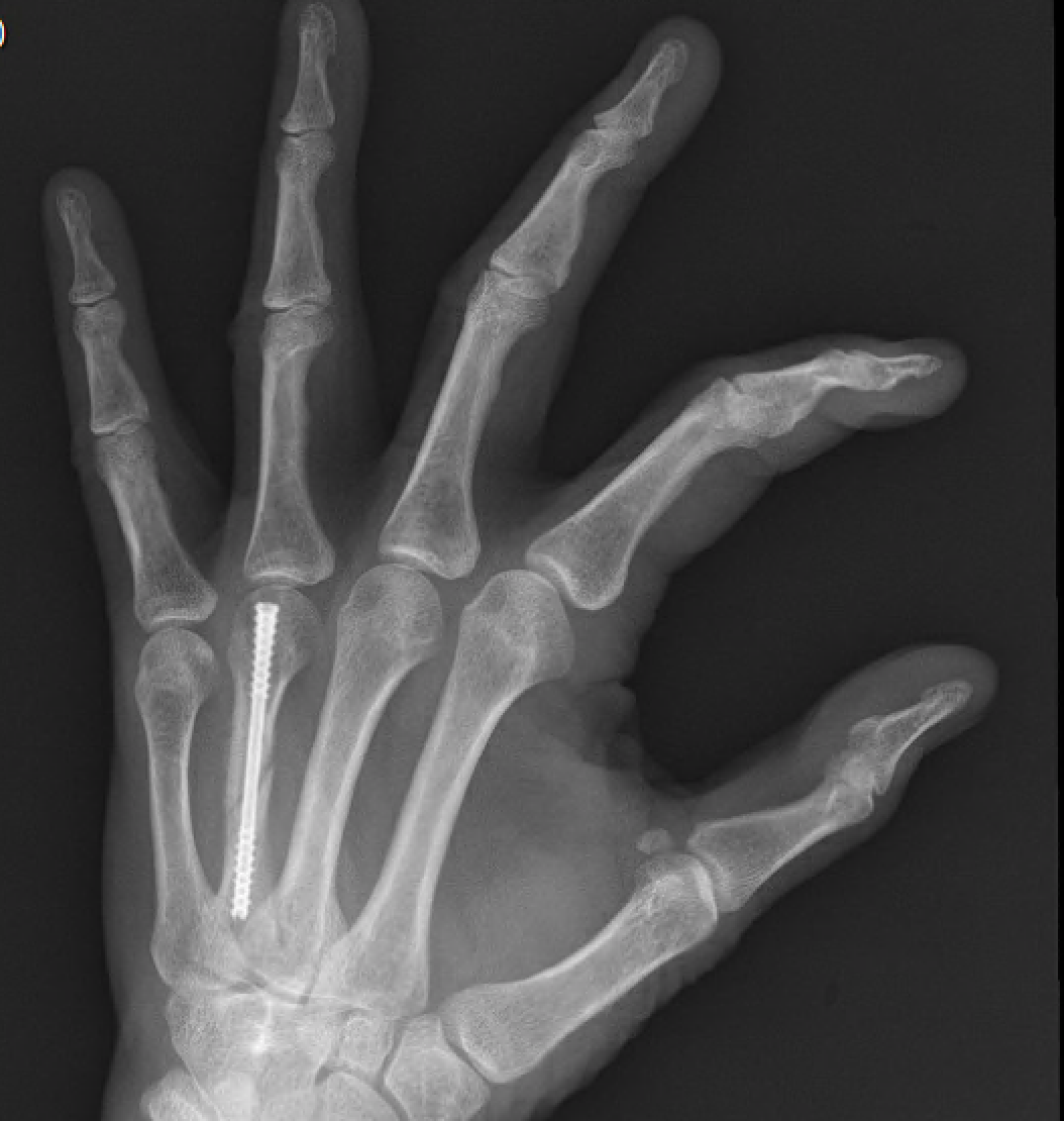 NX Nail for fixation of spiral fracture of fourth metacarpal.